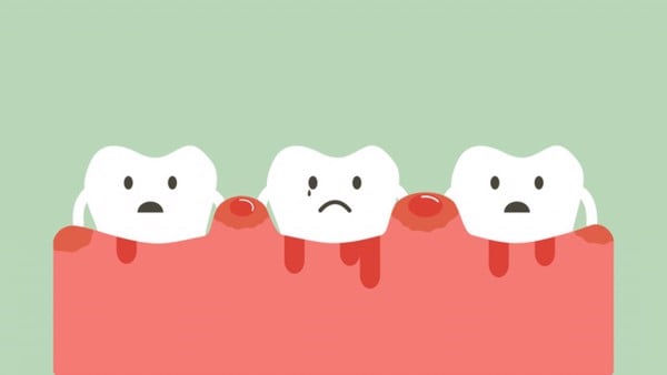 Bệnh viêm nha chu nếu không được xử lý sẽ gây rất nhiều vấn đề răng miệng.