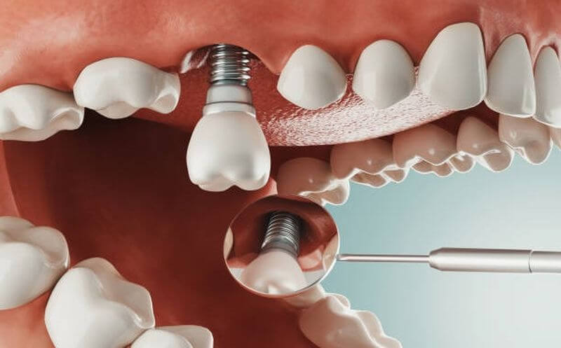 Trồng răng Implant có thể gặp phải những rủi ro nào?