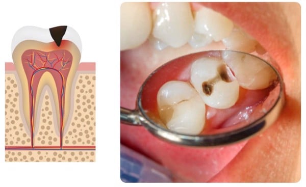 Quy trình trám răng tại nha khoa Home - Nha Khoa Home