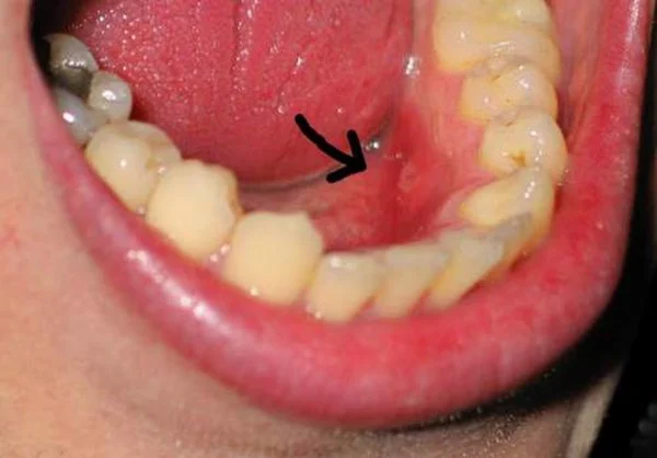 Cách đối phó với nhổ răng khôn đang bị nhiễm trùng - Nha Khoa Home