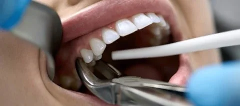 when will dentists pull teeth 1084x480 862f5527b72848a187686985d38d331e large 1