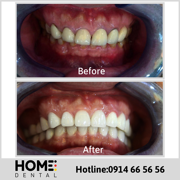 Ảnh răng sứ của anh Vương Tuấn Anh tại Home Dental