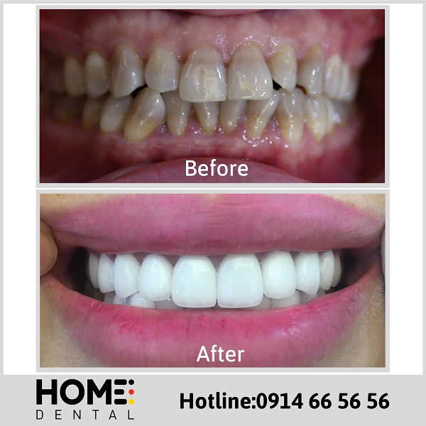 Ảnh răng sứ của chị Hồng Vân tại Home Dental
