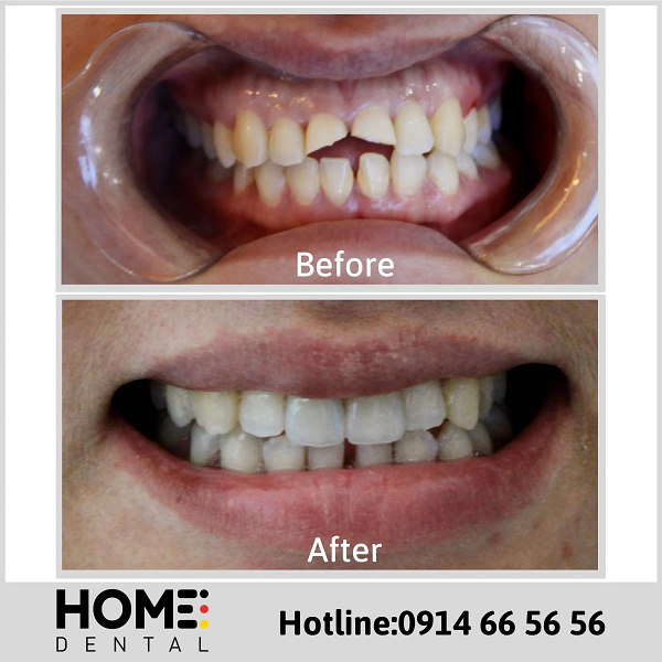 Ảnh răng sứ của chị Trần Giang tại Home Dental