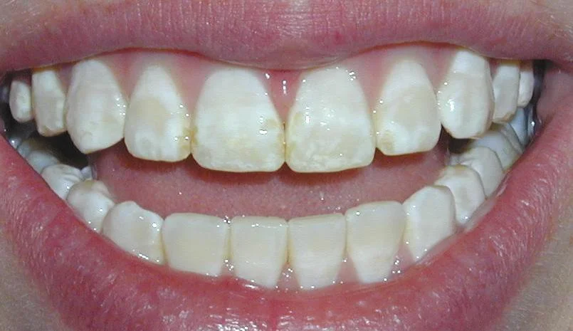 Men răng có thể tự hồi phục lại không? | Vinmec
