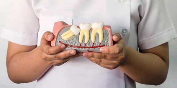 What is wisdom teeth removal?