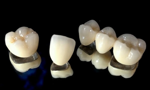 Hình ảnh thực tế một bộ bọc răng thẩm mỹ chất liệu titan.