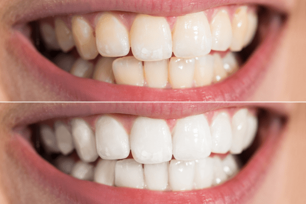 Làm trắng răng bằng công nghệ nha khoa là phương pháp thẩm mỹ cơ bản, đơn giản đối với nhiều người.