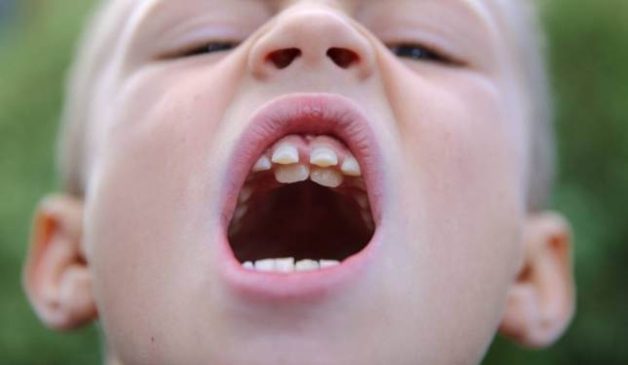 Piezotome và 7 phút nhổ răng thừa gọn gàng cho bé 13 tuổi | TCI Hospital