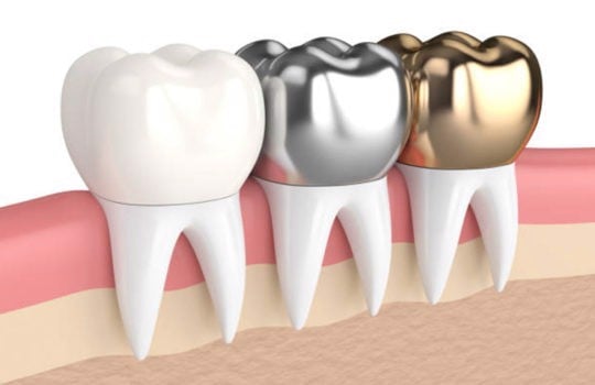 Về cơ bản cầu răng sẽ trở thành một phần của chiếc răng đã được chụp vào.