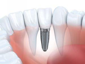 Immediate dental implant and prosthetics services