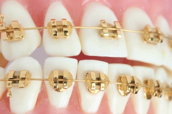 golden-dental-braces