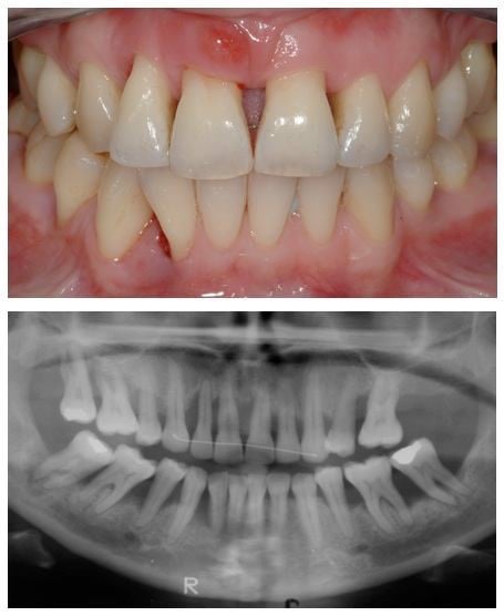 Tình trạng tiêu xương có thể xảy ra với các trường hợp mất răng lâu năm.