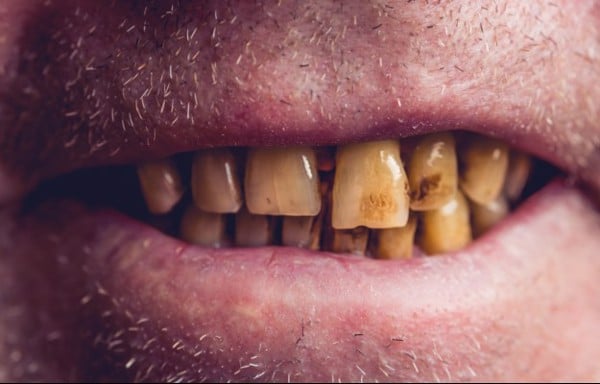 Thuốc lá luôn là một tác nhân gây hại hàng đầu tới sức khỏe răng miệng.