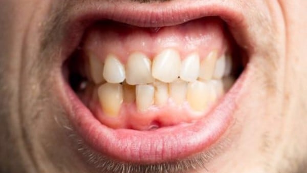 Việc mất răng khiến cho hàm răng của bạn đứng trước nguy cơ bị lệch lạc và phát triển không đồng đều.