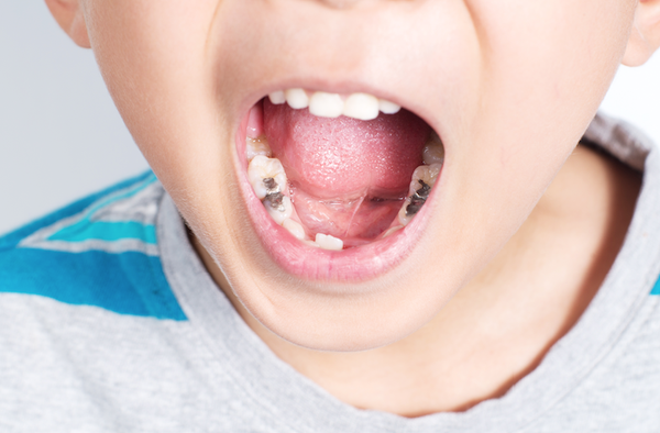Khi trẻ bị sâu răng: Nên nhổ bỏ/trám hay xử lý như thế nào? – Nha Khoa Home