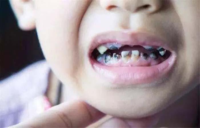 Khi trẻ bị sâu răng: Nên nhổ bỏ/trám hay xử lý như thế nào? - Nha Khoa Home