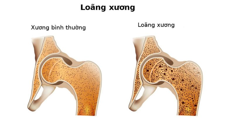 loang xuong co trong duoc rang implant khong 3959