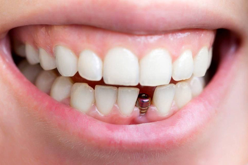 Nghiến răng ảnh hưởng nghiêm trọng đến trồng răng Implant như thế nào? - Nha Khoa Home