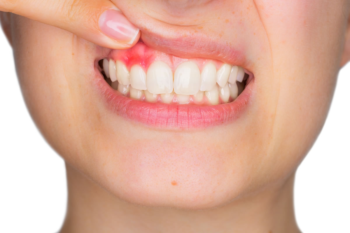 Nguyên nhân nướu bị sưng, răng có mủ và cách điều trị hiệu quả - Nha Khoa Home