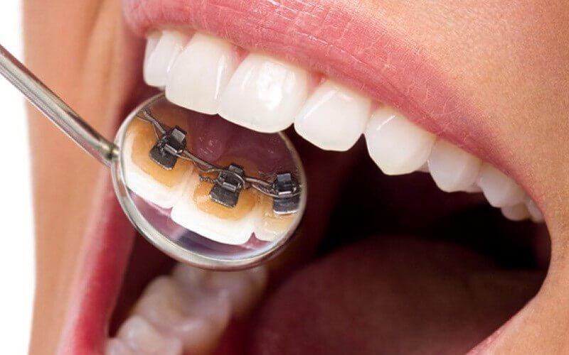 Niềng răng mắc cài kim loại mặt trong là gì? Phù hợp với trường hợp nào?