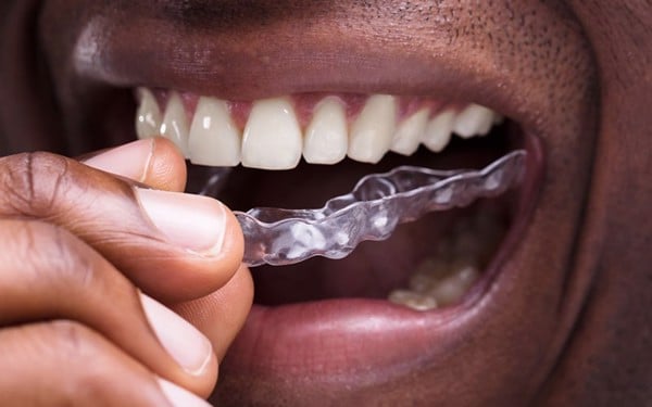 Răng nhạy cảm là gì? Những điều bạn cần biết về răng nhạy cảm - Nha Khoa Home