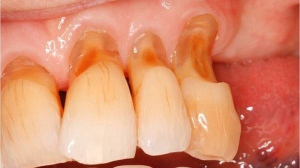 Răng vỡ, mất răng nhưng còn chân răng phục hồi ra sao? - Nha Khoa Home