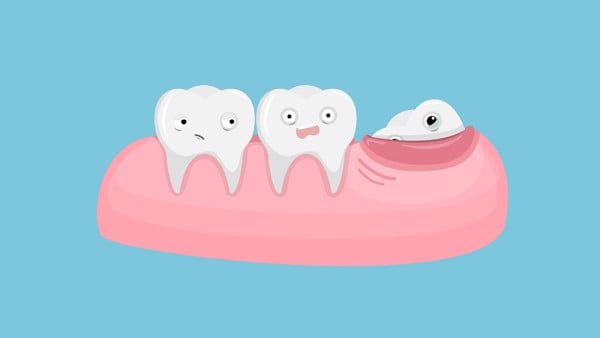 Răng khôn nếu không được nhổ bỏ khi cần sẽ gây ra nhiều ảnh hưởng xấu tới sức khỏe răng miệng.