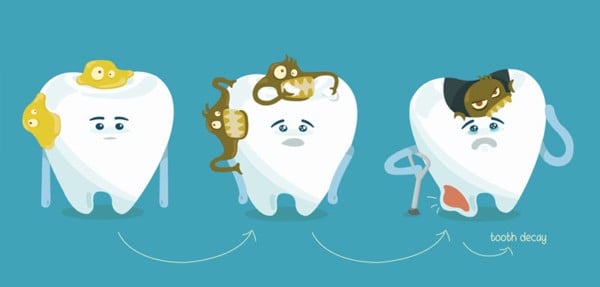 Sâu răng là bệnh lý răng miệng rất phổ biến.