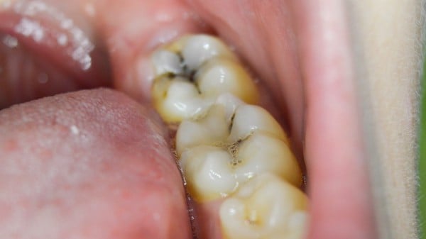 Sâu răng và những điều bạn cần biết - Nha Khoa Home