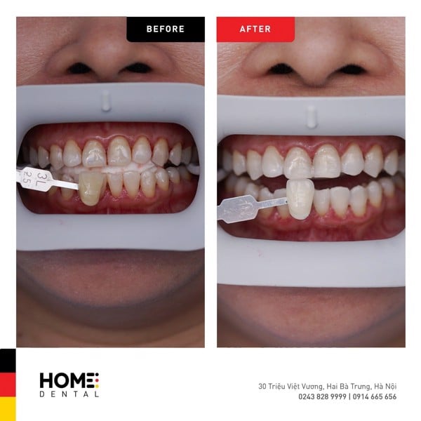 Siêu khuyến mại tẩy trắng răng công nghệ Laser mỹ tại nha khoa Home - Nha Khoa Home
