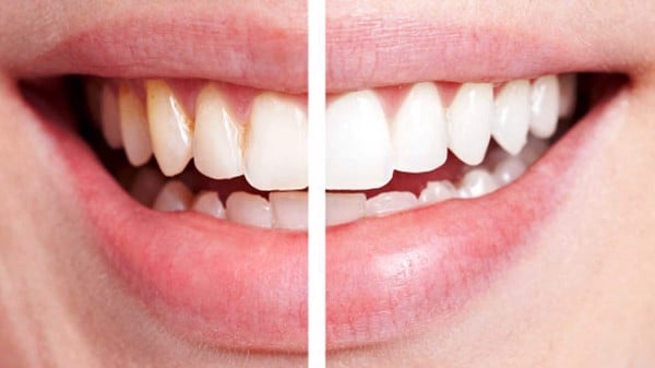 Tẩy trắng răng là gì? Những điều cần biết về tẩy trắng răng - Nha Khoa Home