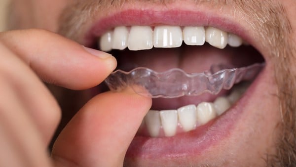 Làm trắng răng tại nhà khá thuận tiện cho một số người không có thời gian tới nha sĩ.