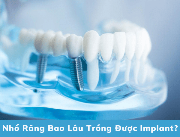 Nho Rang Bao Lau Trong Duoc Implant