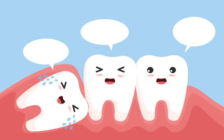 Răng khôn là gì? Những kiến thức cần biết khi nhổ răng khôn