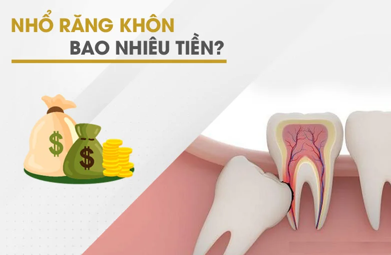 Nhổ răng khôn bao nhiêu tiền là hợp lý nhất tại Nha Khoa Kim