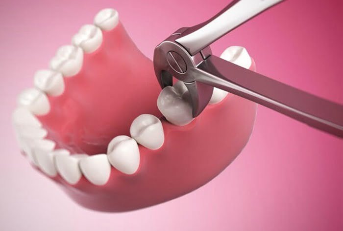 Nhổ răng hàm dưới – Trường hợp nào phải nhổ bỏ, có nguy hiểm không?