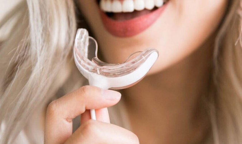 Máy tẩy trắng răng tại nhà có tốt không?