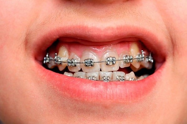 Biểu hiện của viêm lợi khi niềng răng