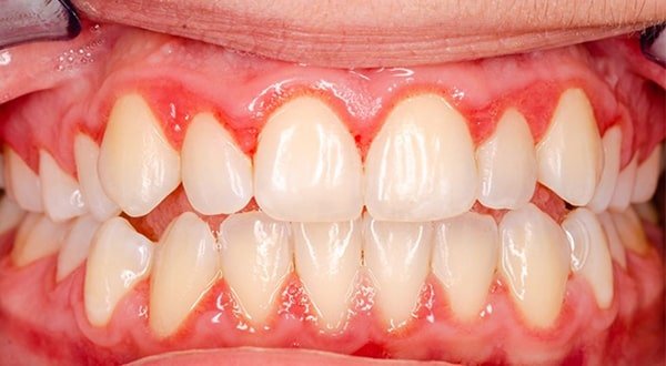 Nguyên nhân bị viêm lợi khi bọc răng sứ