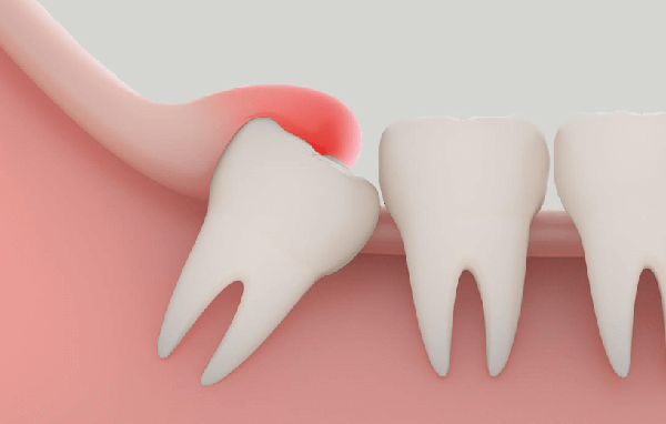 Biến chứng viêm lợi khi mọc răng khôn