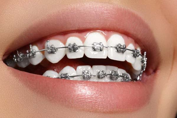 Lựa chọn loại phương pháp niềng răng thích hợp