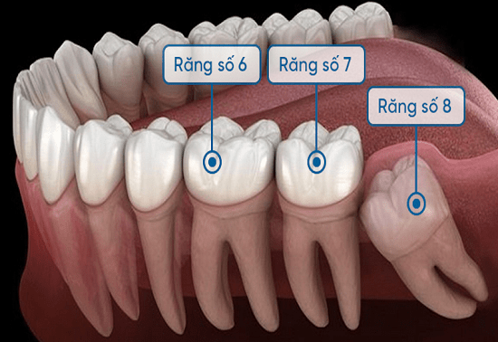 Răng số 7 bị lung lay sau khi nhổ răng số 8