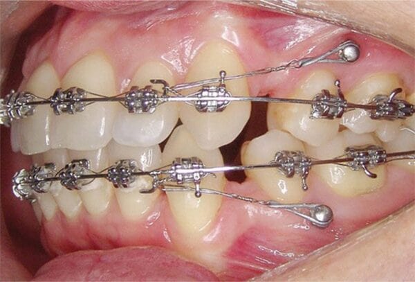 Cắm vít trong quá trình niềng răng gây ra biến chứng g