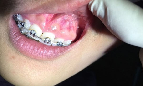 Nguyên nhân bị tiêu xương khi niềng răng 