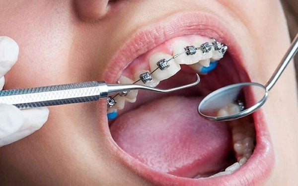 Niềng răng bao lâu siết một lần