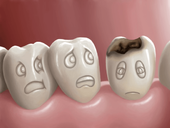 Làm gì khi răng bị sâu ăn mòn hết?