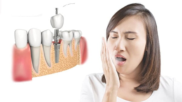 Trồng răng implant có chắc chắn bị hôi miệng không