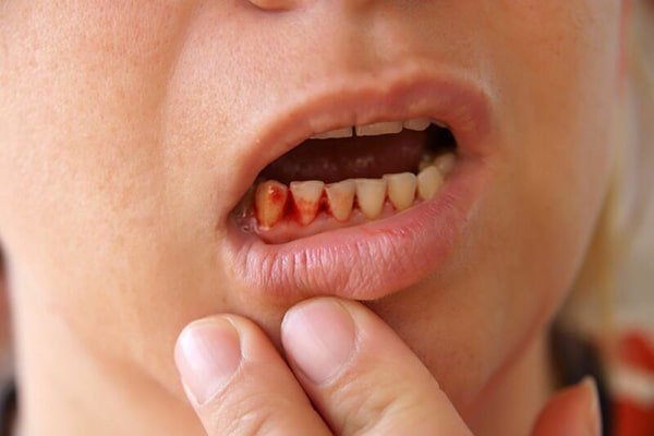 Chảy máu răng do bị thiếu chất gì?