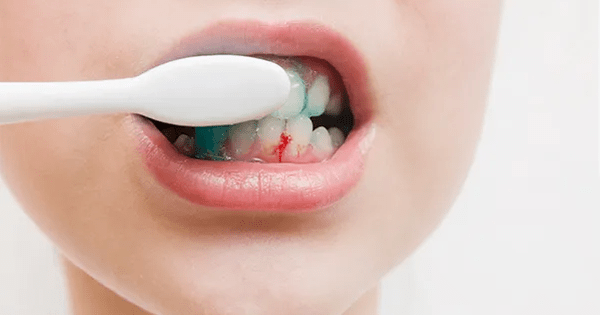 Đánh răng bị chảy máu có nguy hiểm không